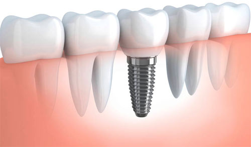 Dental implant in dwarka Dental implant in dwarka