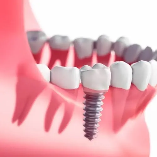 Importance of Dental Implants Importance of Dental Implants