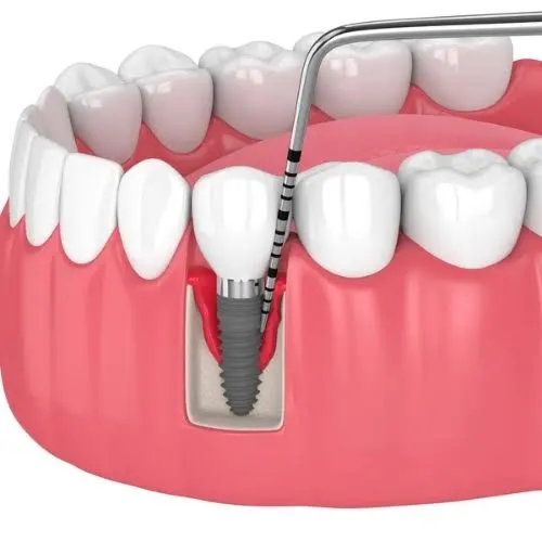 Importance of Periodontics in Dental Implants Importance of Periodontics in Dental Implants